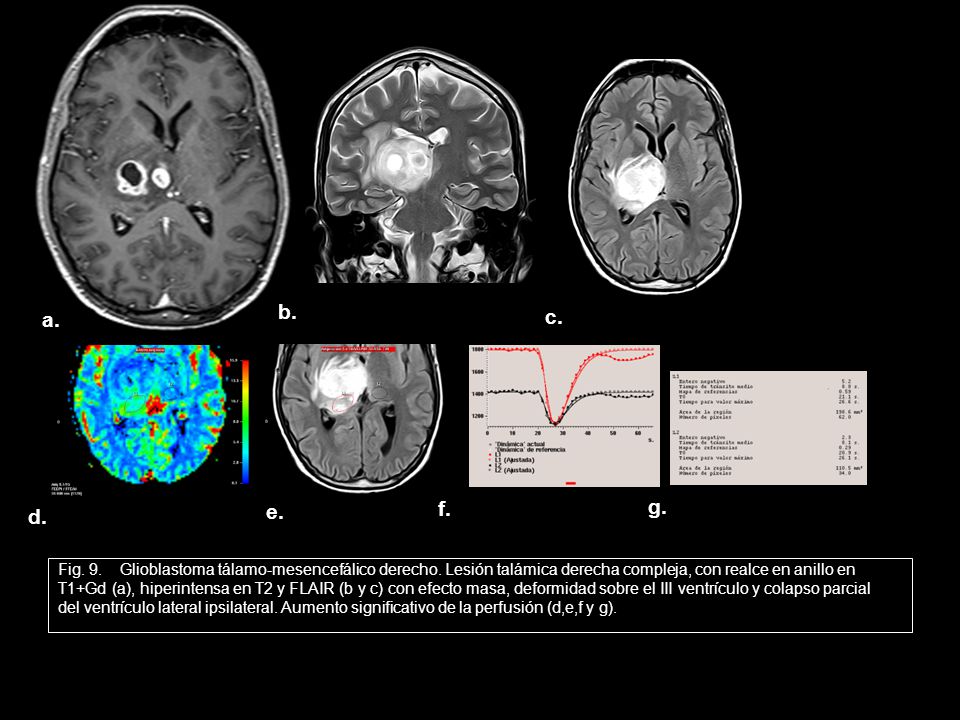 b. a. c. d. e. f. g. Fig. 9. Glioblastoma tálamo-mesencefálico derecho. Lesión talámica derecha compleja, con realce en anillo en.