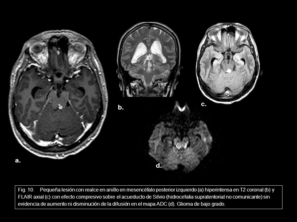 c. b. a. d. Fig. 10. Pequeña lesión con realce en anillo en mesencéfalo posterior izquierdo (a) hiperintensa en T2 coronal (b) y.
