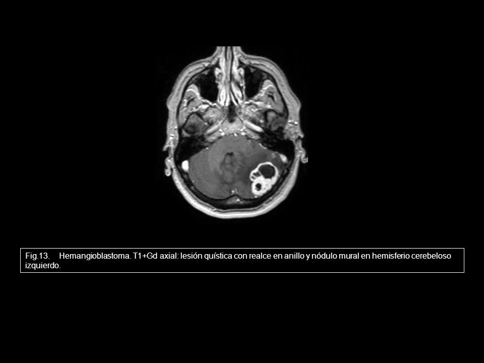 EXISTEN 3 TIPOS MORFOLÓGICOS DE TUMOR