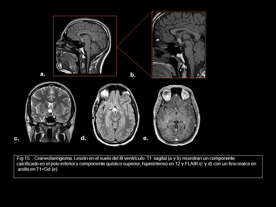a. b. c. d. e. Fig 15. Craneofaringioma. Lesión en el suelo del III ventrículo. T1 sagital (a y b) muestran un componente.