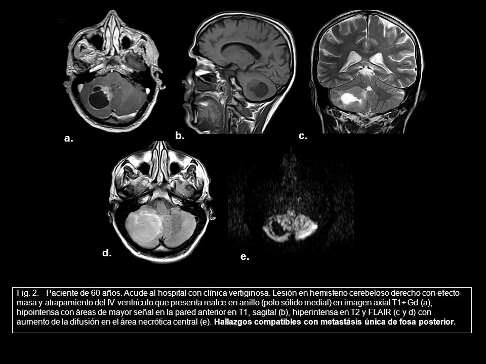 a. b. c. d. e. Fig. 2. Paciente de 60 años. Acude al hospital con clínica vertiginosa. Lesión en hemisferio cerebeloso derecho con efecto.
