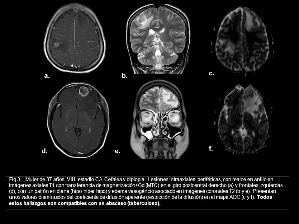 c. a. b. f. d. e. Fig.3. Mujer de 37 años. VIH, estadio C3. Cefalea y diplopia. Lesiones intraaxiales, periféricas, con realce en anillo en.