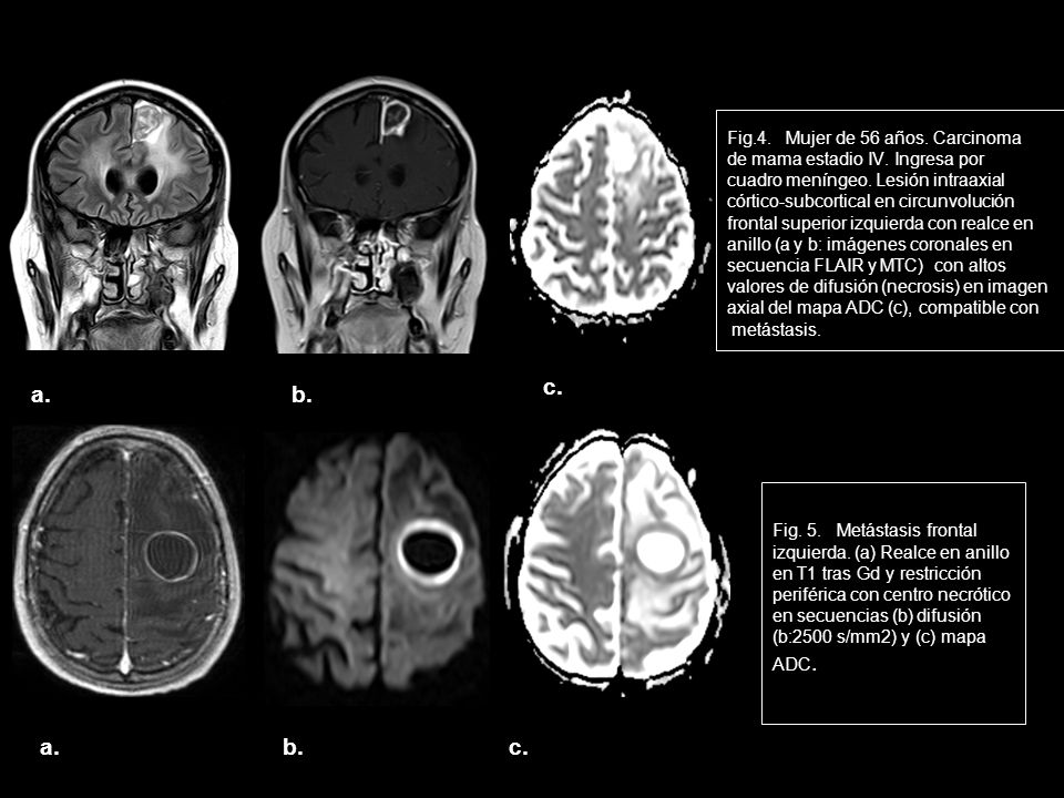 c. a. b. a. b. c. Fig.4. Mujer de 56 años. Carcinoma