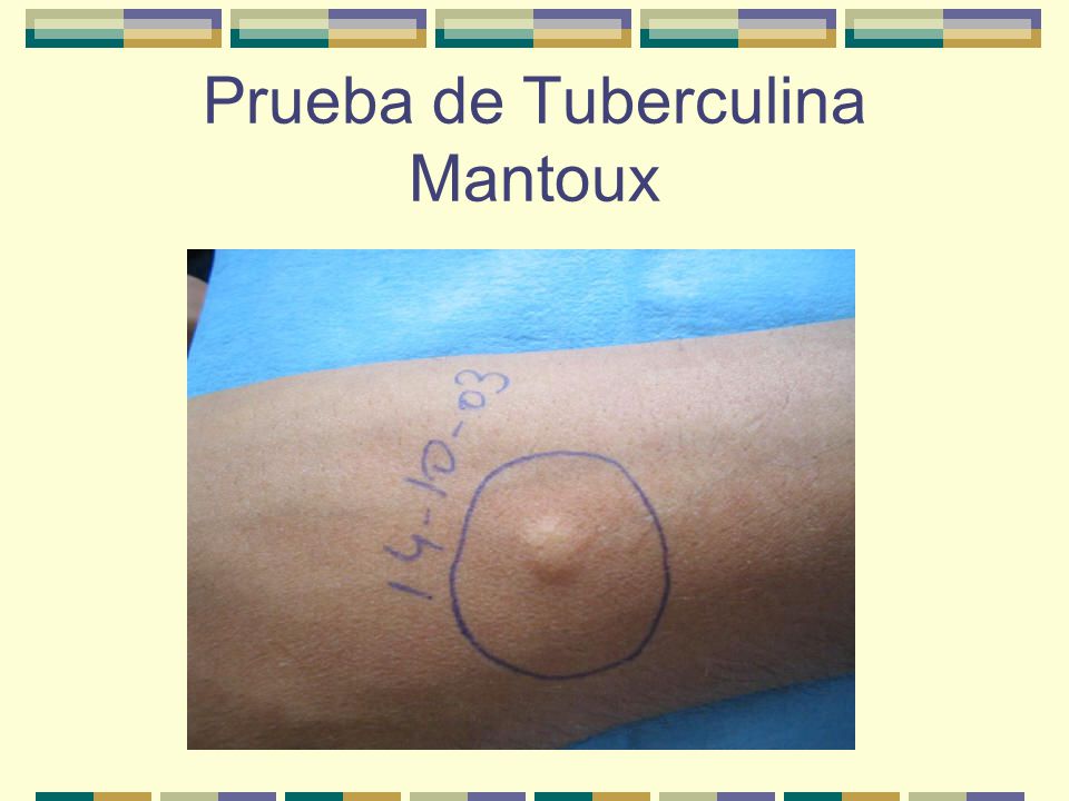 Prueba de Tuberculina Mantoux