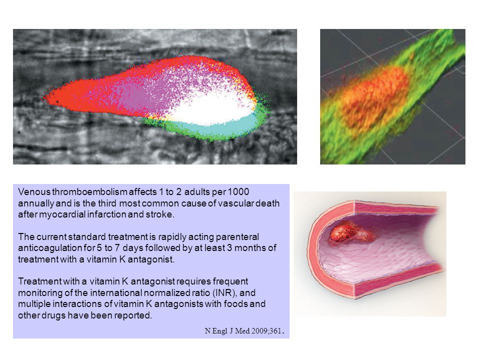 Venous thromboembolism affects 1 to 2 adults per 1000 annually and is the third most common cause of vascular death after myocardial infarction and stroke.