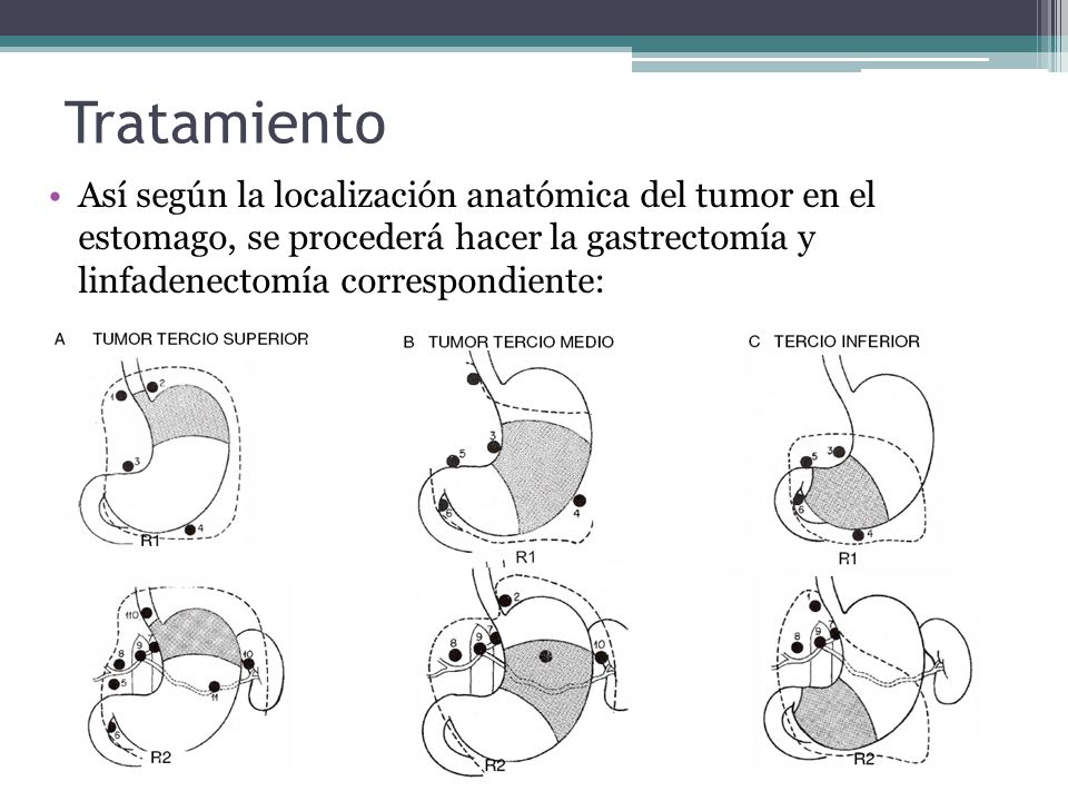 Tratamiento Así según la localización anatómica del tumor en el estomago, se procederá hacer la gastrectomía y linfadenectomía correspondiente: