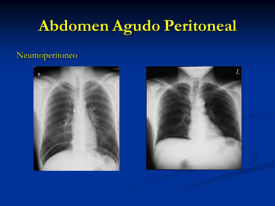 Abdomen Agudo Peritoneal