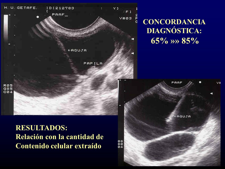 CONCORDANCIA DIAGNÓSTICA: 65% »» 85% RESULTADOS: Relación con la cantidad de.