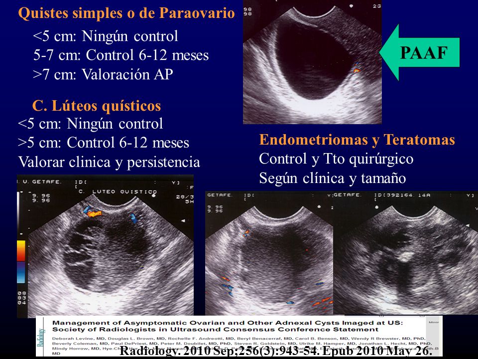 PAAF Quistes simples o de Paraovario <5 cm: Ningún control