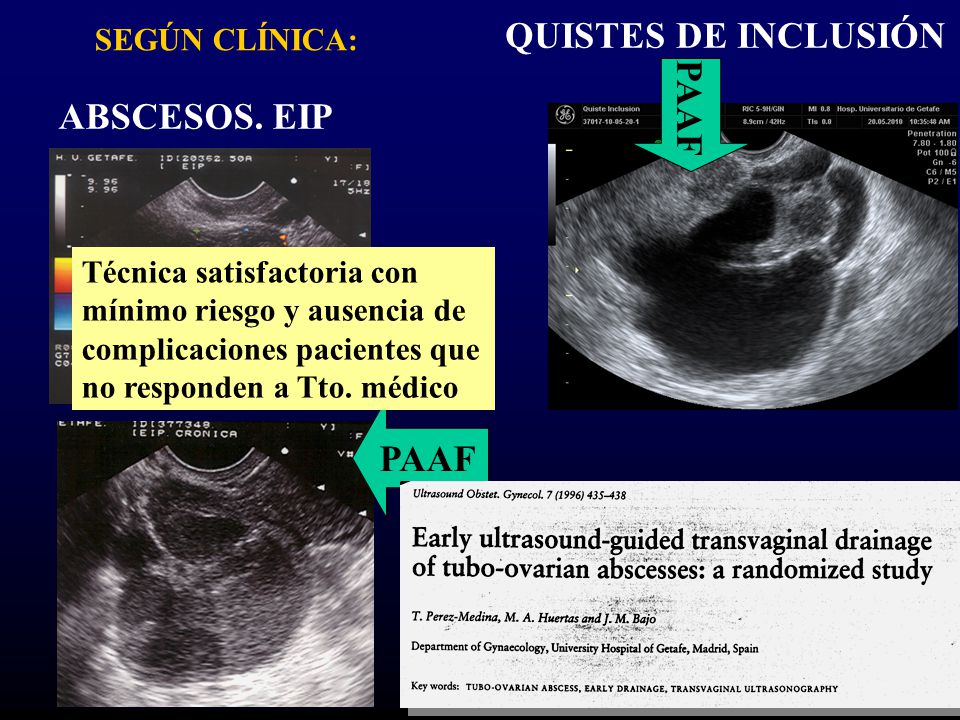 QUISTES DE INCLUSIÓN PAAF ABSCESOS. EIP PAAF SEGÚN CLÍNICA: