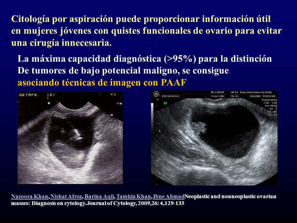 Citología por aspiración puede proporcionar información útil