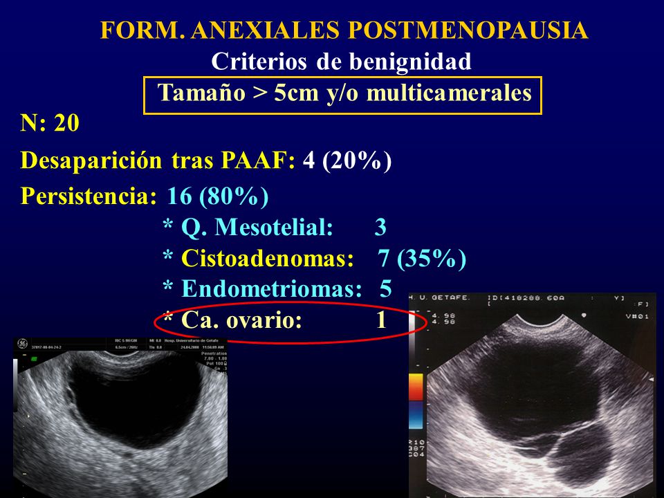 FORM. ANEXIALES POSTMENOPAUSIA Criterios de benignidad Tamaño > 5cm y/o multicamerales