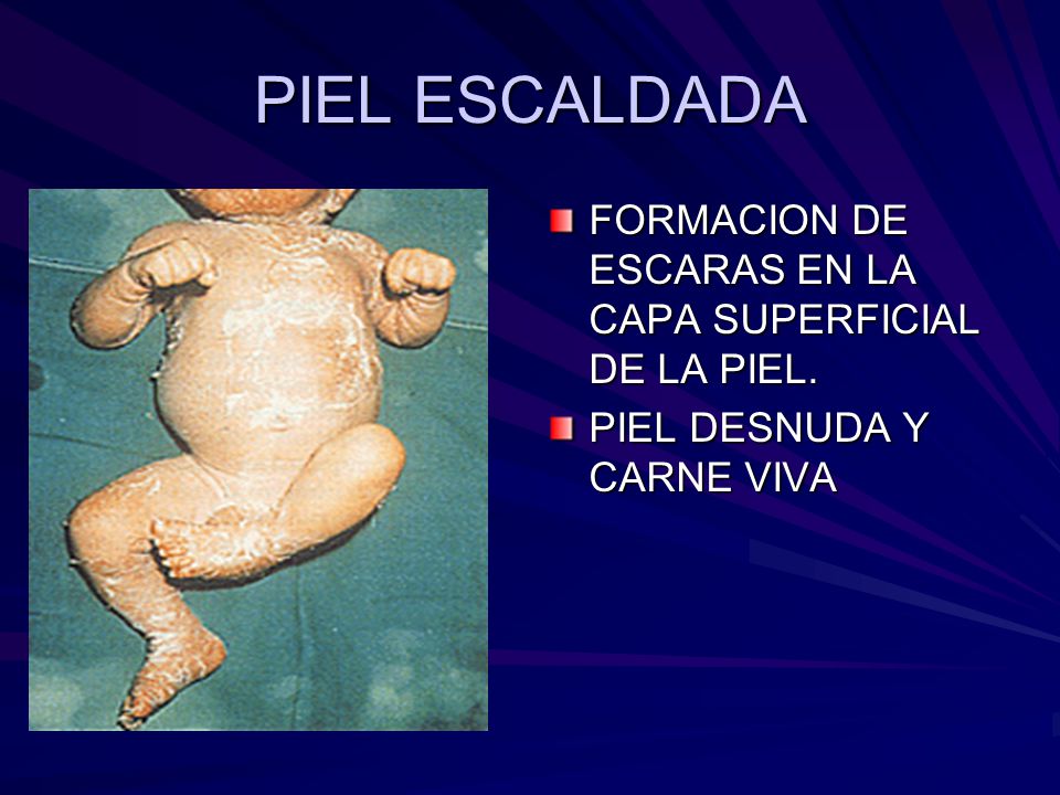 PIEL ESCALDADA FORMACION DE ESCARAS EN LA CAPA SUPERFICIAL DE LA PIEL.