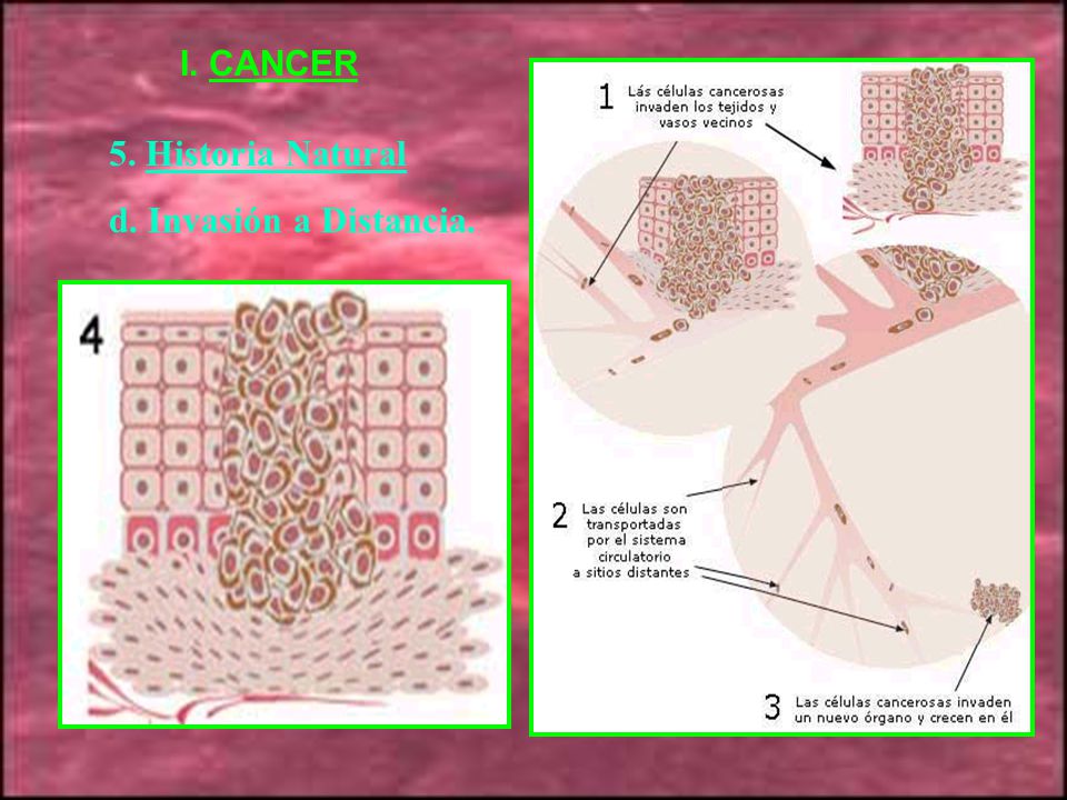 I. CANCER 5. Historia Natural d. Invasión a Distancia.