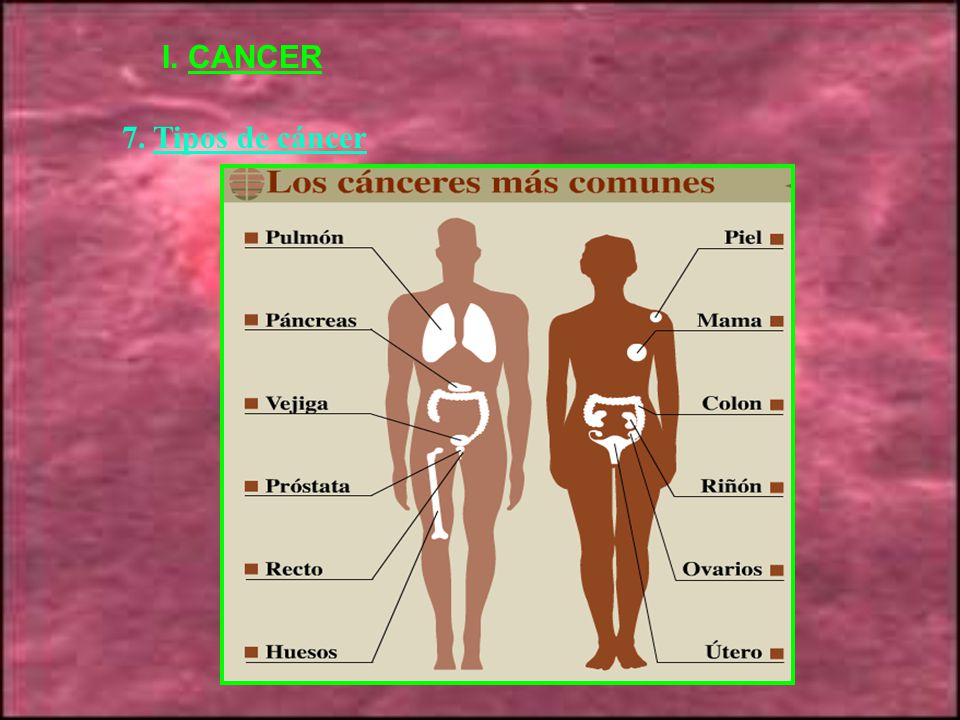 I. CANCER 7. Tipos de cáncer