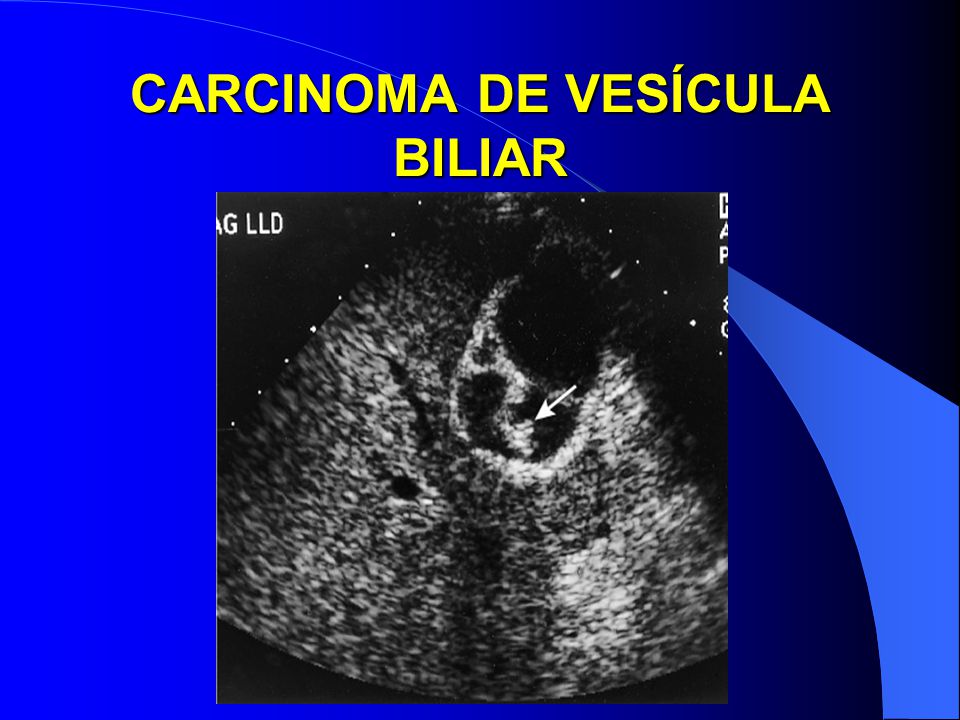 CARCINOMA DE VESÍCULA BILIAR