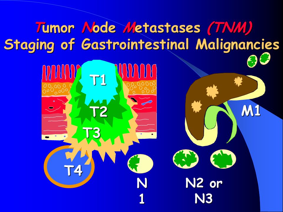 Tumor Node Metastases (TNM) Staging of Gastrointestinal Malignancies
