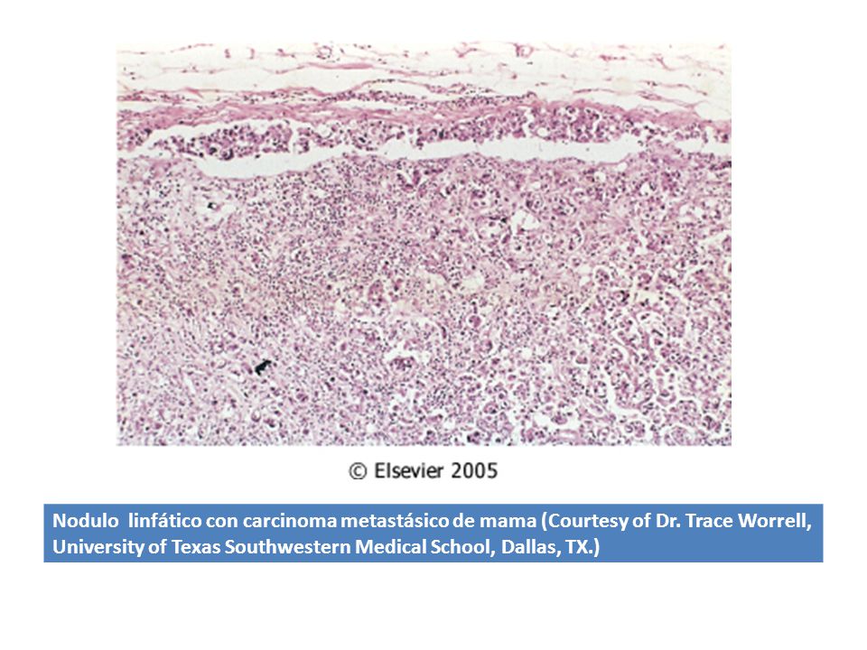 Nodulo linfático con carcinoma metastásico de mama (Courtesy of Dr