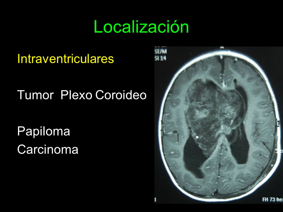 Localización Intraventriculares Tumor Plexo Coroideo Papiloma Carcinoma