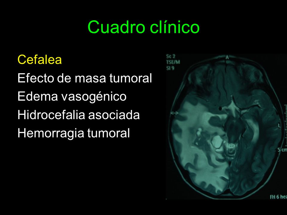 Cuadro clínico Cefalea Efecto de masa tumoral Edema vasogénico Hidrocefalia asociada Hemorragia tumoral