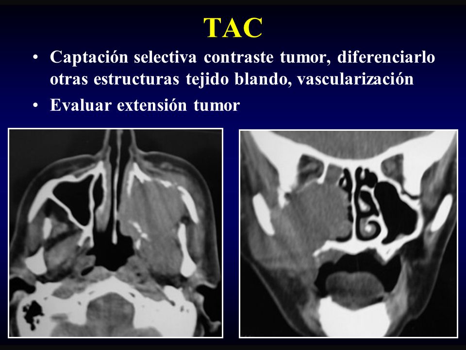 TAC Captación selectiva contraste tumor, diferenciarlo otras estructuras tejido blando, vascularización.