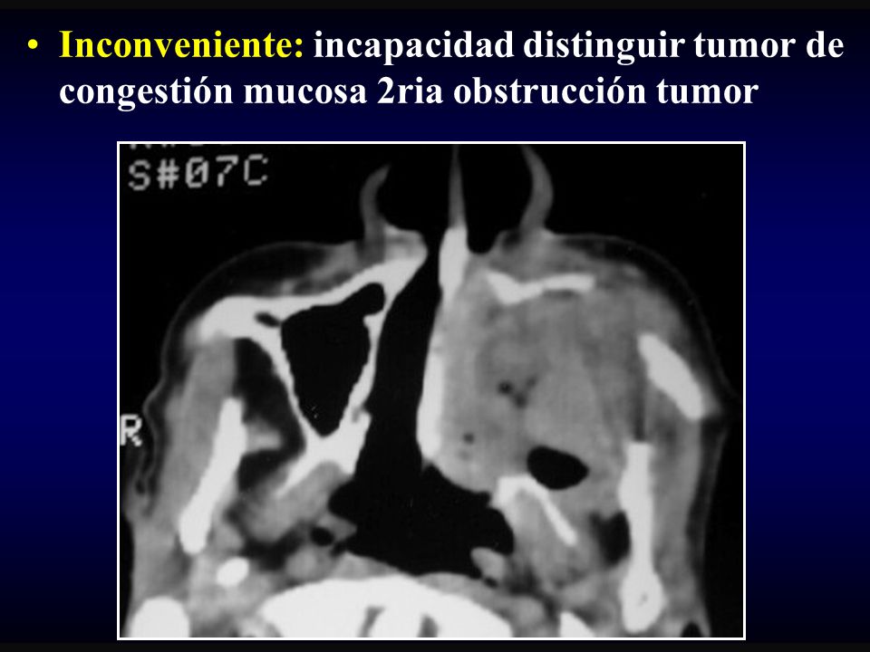 Inconveniente: incapacidad distinguir tumor de congestión mucosa 2ria obstrucción tumor