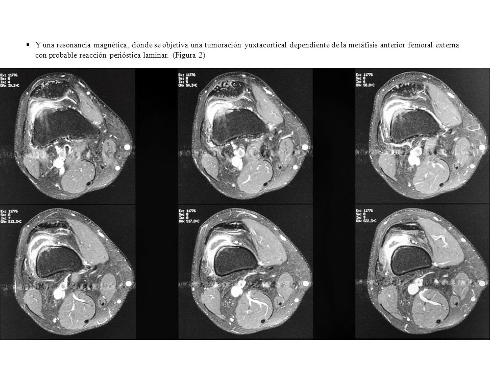 Y una resonancia magnética, donde se objetiva una tumoración yuxtacortical dependiente de la metáfisis anterior femoral externa con probable reacción perióstica laminar.