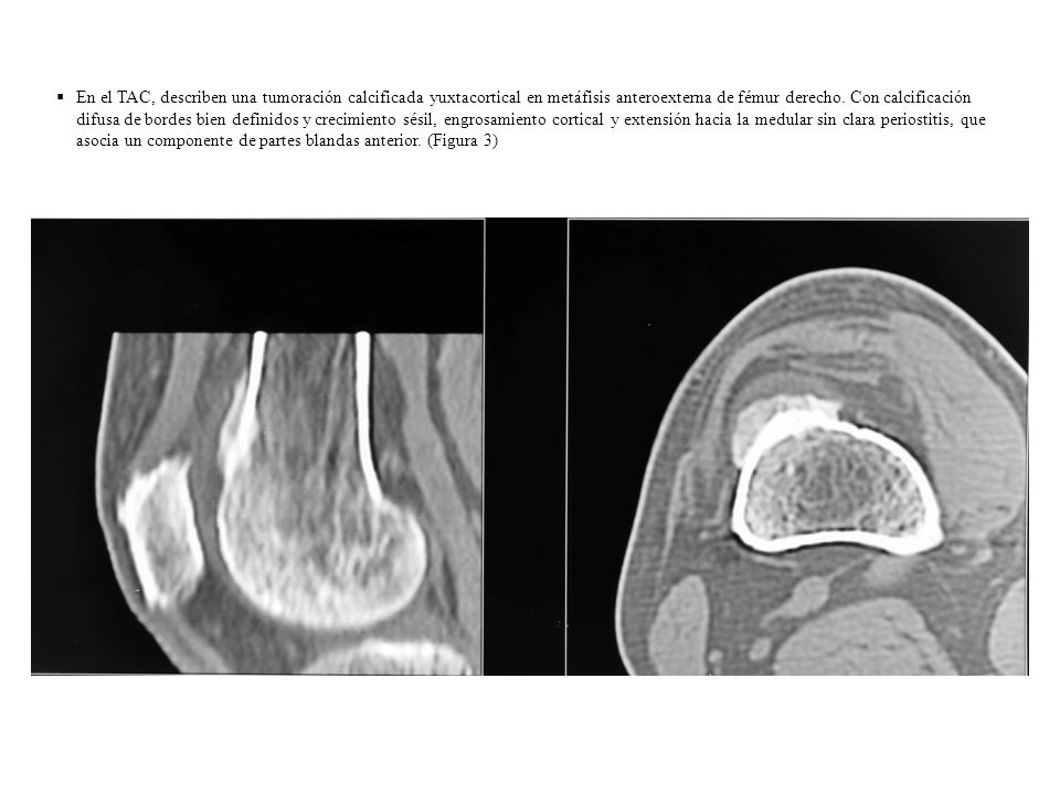 En el TAC, describen una tumoración calcificada yuxtacortical en metáfisis anteroexterna de fémur derecho.