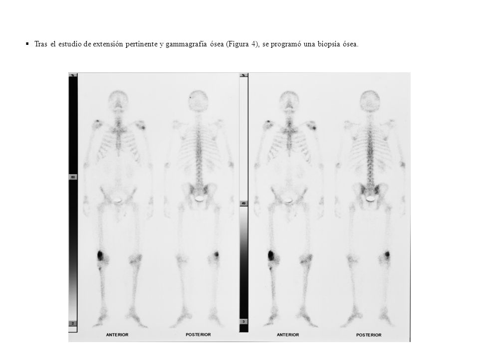Tras el estudio de extensión pertinente y gammagrafía ósea (Figura 4), se programó una biopsia ósea.