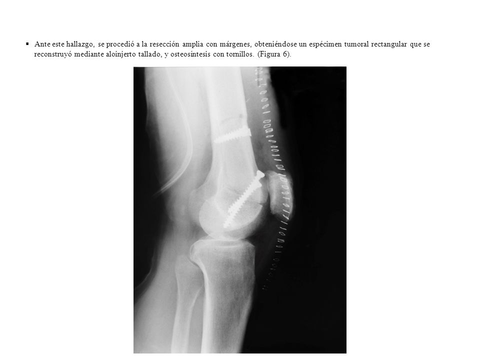 Ante este hallazgo, se procedió a la resección amplia con márgenes, obteniéndose un espécimen tumoral rectangular que se reconstruyó mediante aloinjerto tallado, y osteosíntesis con tornillos.