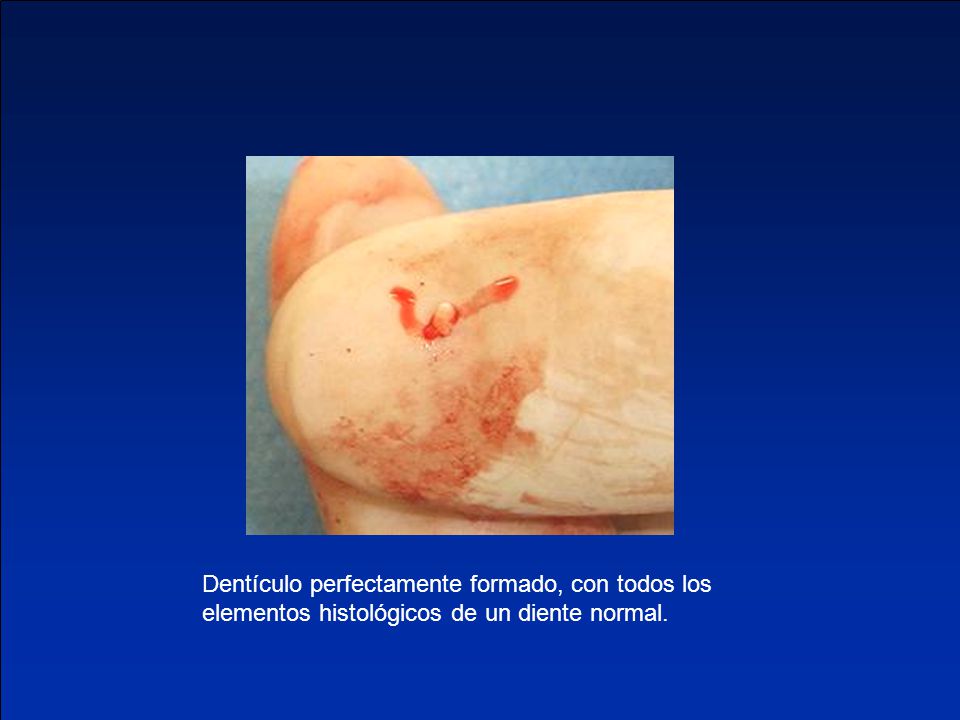Dentículo perfectamente formado, con todos los elementos histológicos de un diente normal.