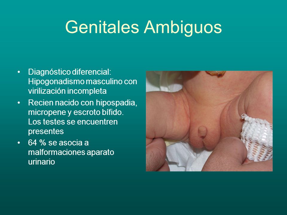 Genitales Ambiguos Diagnóstico diferencial: Hipogonadismo masculino con virilización incompleta.