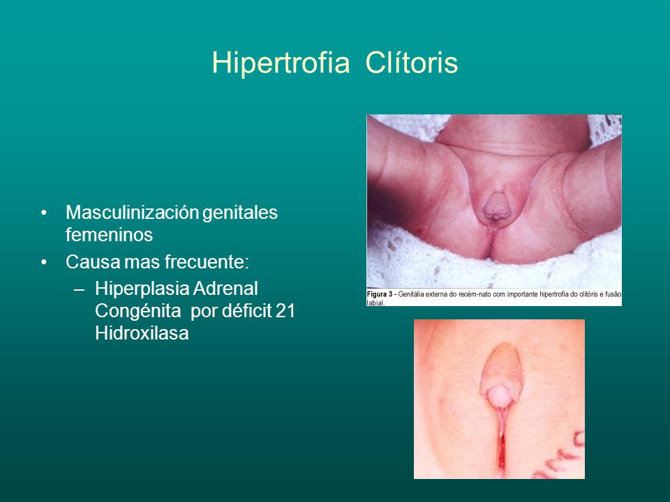 Hipertrofia Clítoris Masculinización genitales femeninos