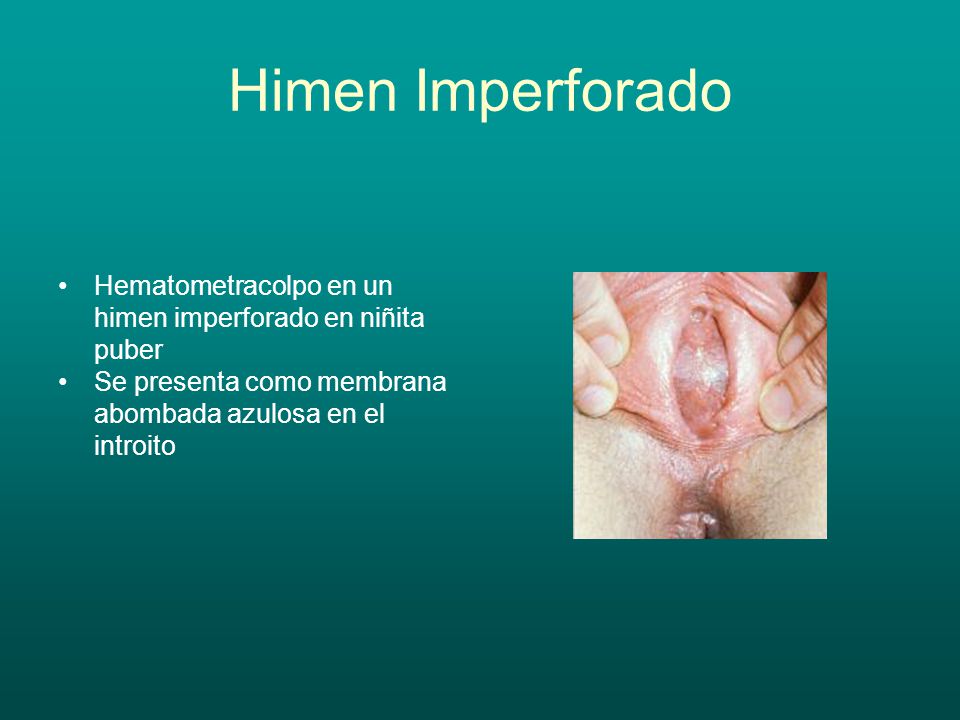 Himen Imperforado Hematometracolpo en un himen imperforado en niñita puber.