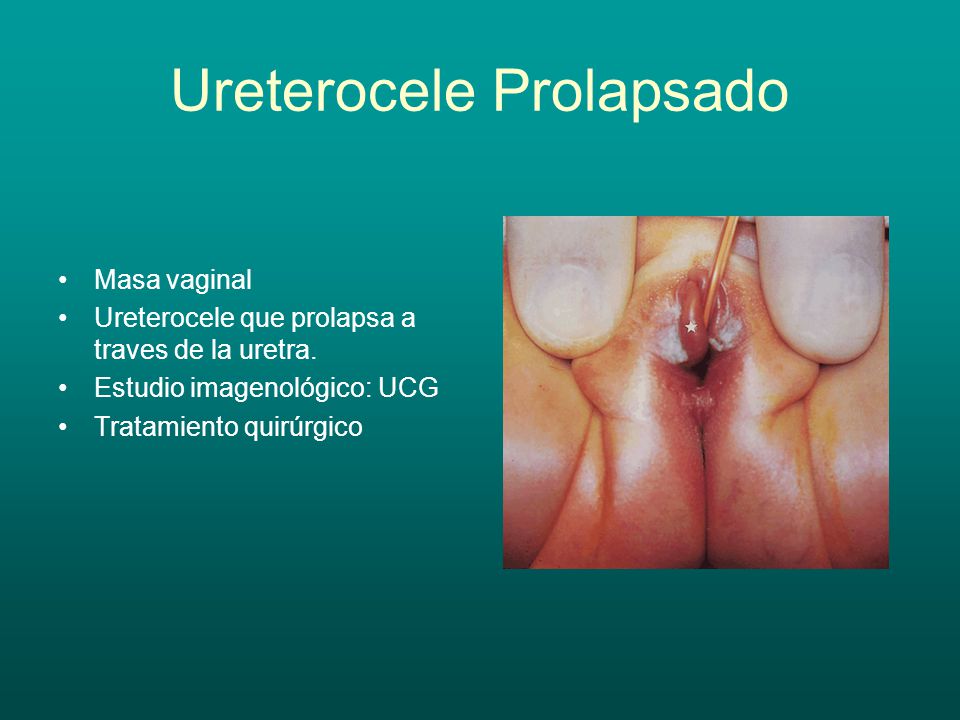 Ureterocele Prolapsado