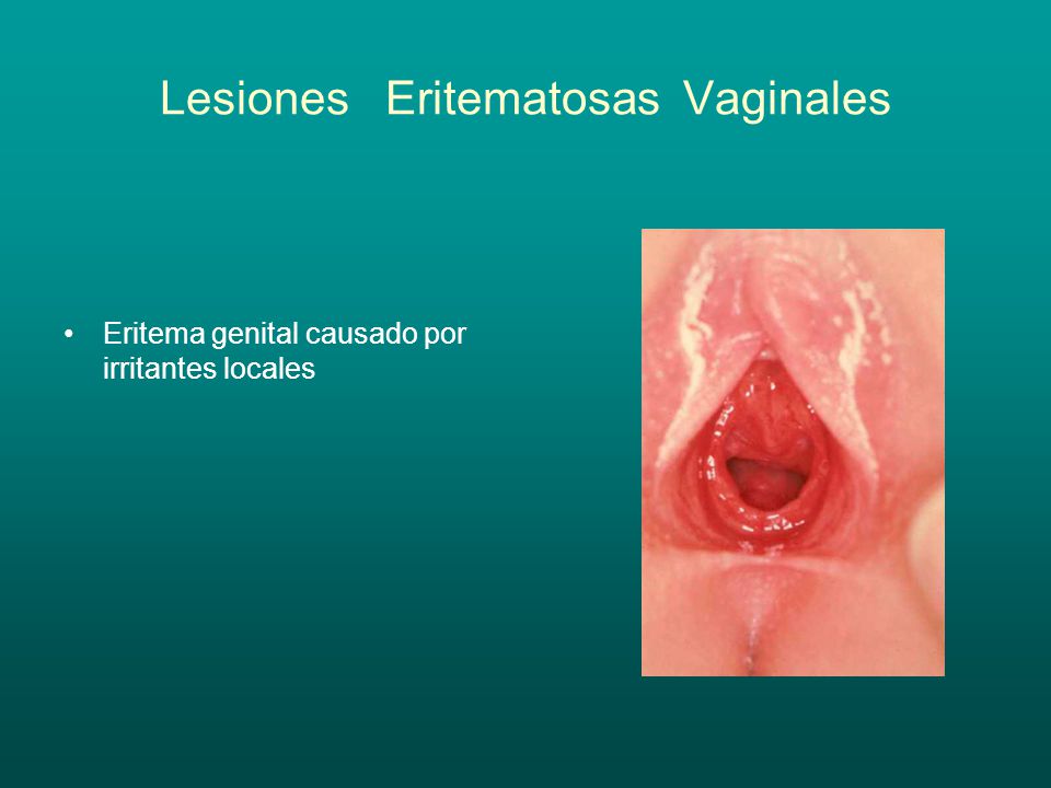 Lesiones Eritematosas Vaginales