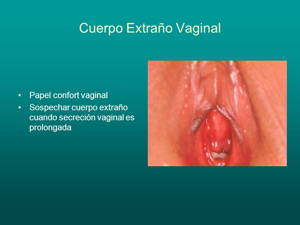 Cuerpo Extraño Vaginal