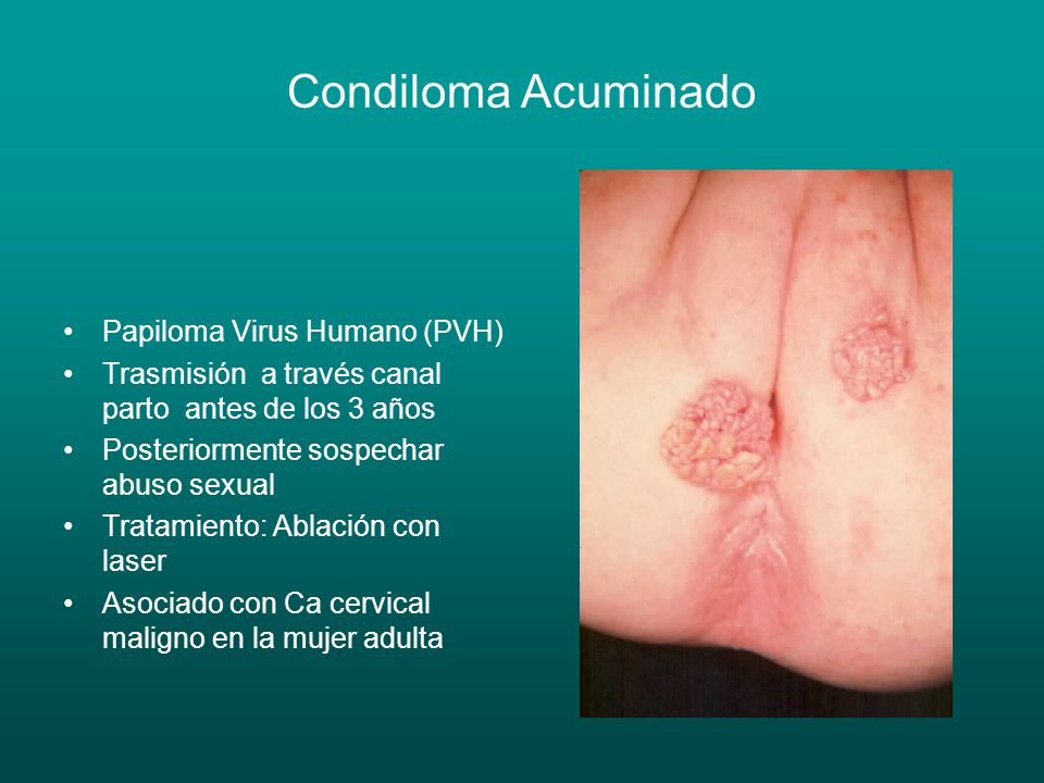 Condiloma Acuminado Papiloma Virus Humano (PVH)