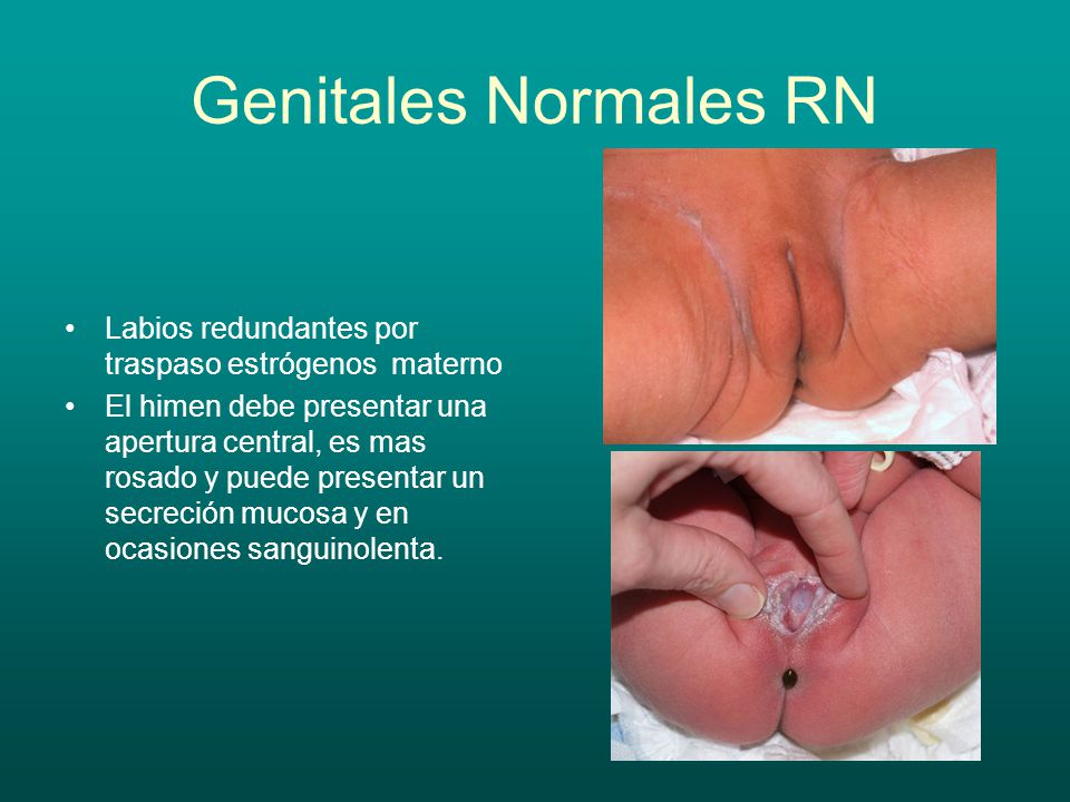 Genitales Normales RN Labios redundantes por traspaso estrógenos materno.