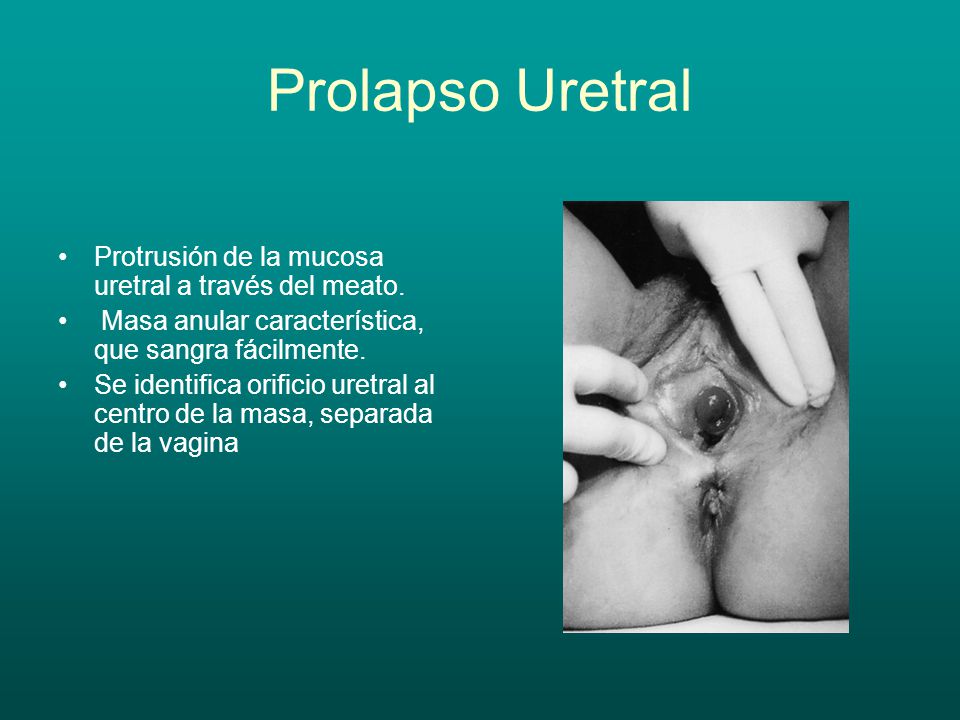 Prolapso Uretral Protrusión de la mucosa uretral a través del meato.