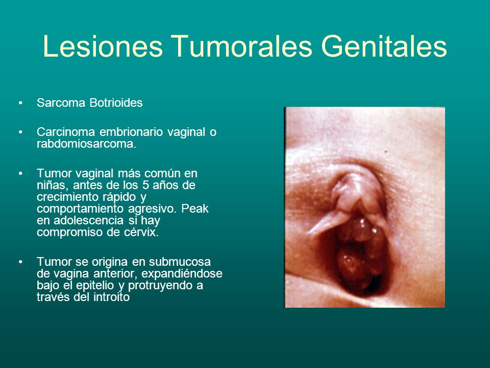 Lesiones Tumorales Genitales