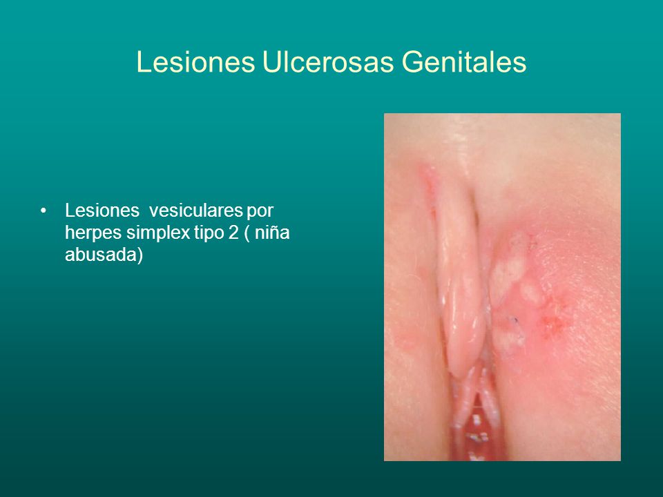 Lesiones Ulcerosas Genitales