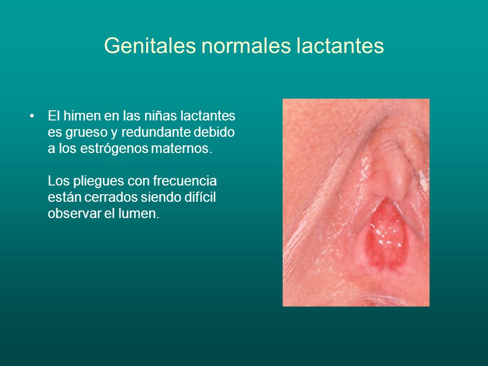 Genitales normales lactantes