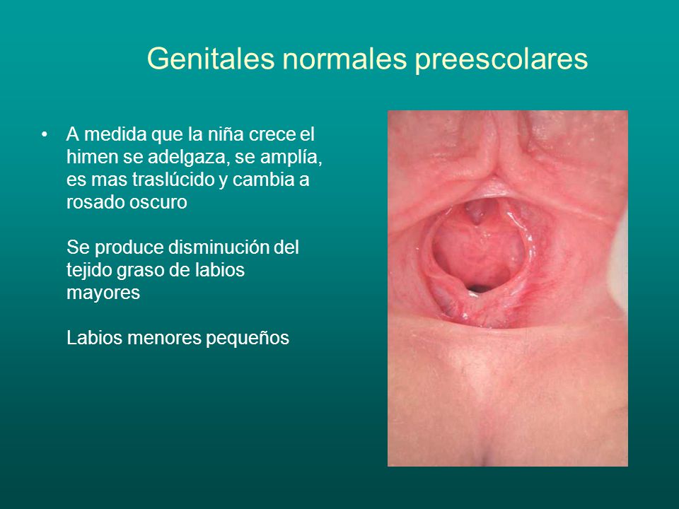 Genitales normales preescolares