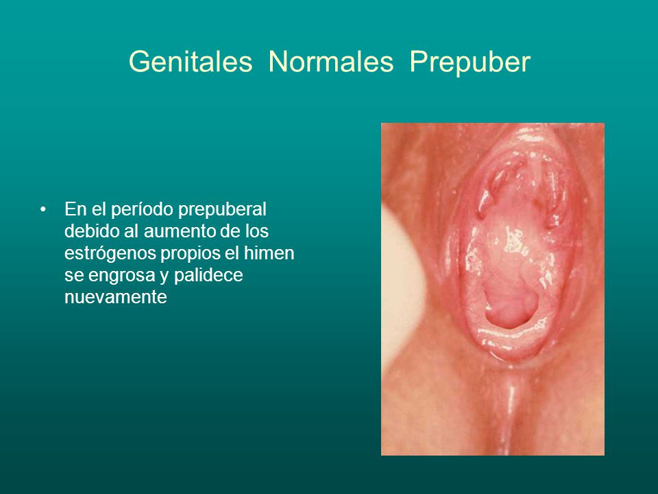 Genitales Normales Prepuber