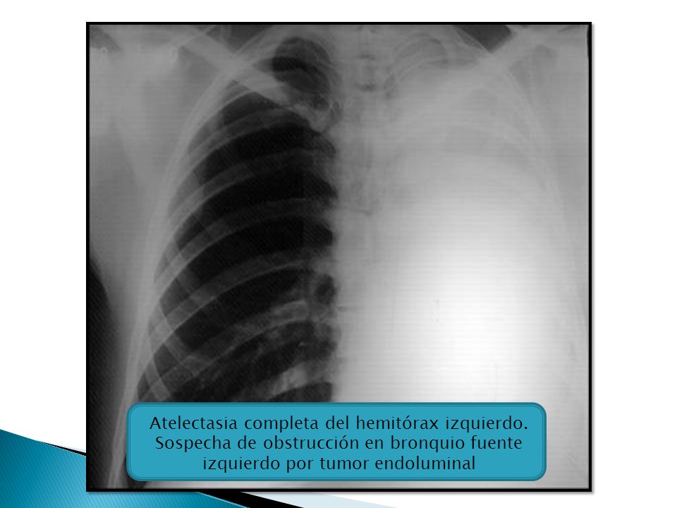 Rx Tórax: atelectasia completa de hemitórax izquierdo, se evidencia radioopacidad con raquis desnudo