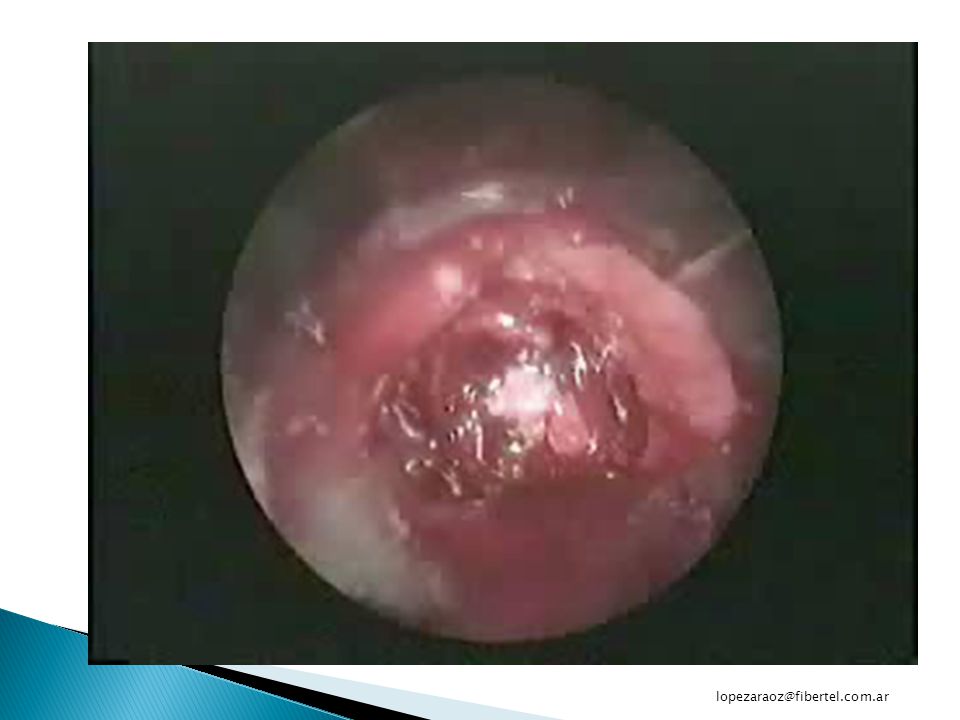 Se realiza desobstrucción con fibrobronco Rígido y electrocoagulacion, con permeabilización del bronquio fuente izquierdo.
