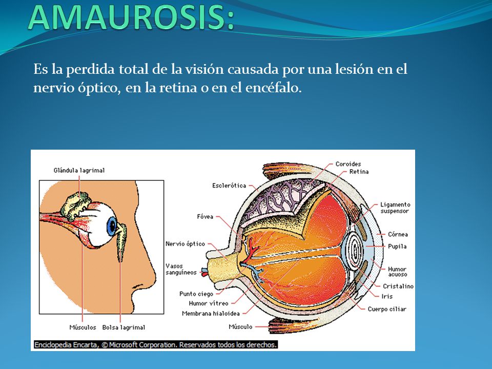 AMAUROSIS: Es la perdida total de la visión causada por una lesión en el nervio óptico, en la retina o en el encéfalo.