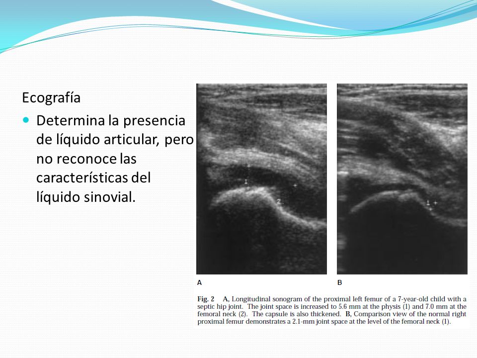 Ecografía Determina la presencia de líquido articular, pero no reconoce las características del líquido sinovial.