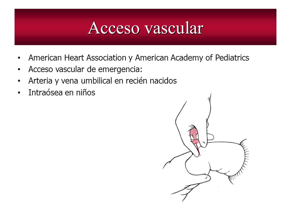 Acceso vascular American Heart Association y American Academy of Pediatrics. Acceso vascular de emergencia:
